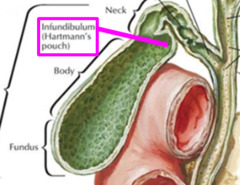 Баня желчный пузырь. Карман Гартмана в желчном пузыре это. Желчный пузырь анатомия карман Гартмана. Гартманов карман желчный пузырь. Карман Хартмана желчный пузырь.